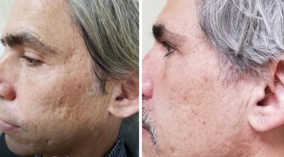 A before and after example of a man receiving RF microneedling treatment for acne scars at Aglow Dermatology.