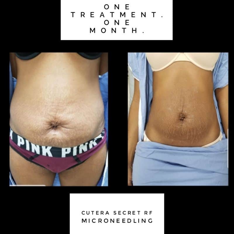 A before and after example of a woman receiving RF microneedling treatment for abdominal stretch marks at Aglow Dermatology.