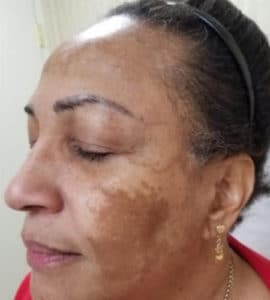 Vi peel before melasma 1 month