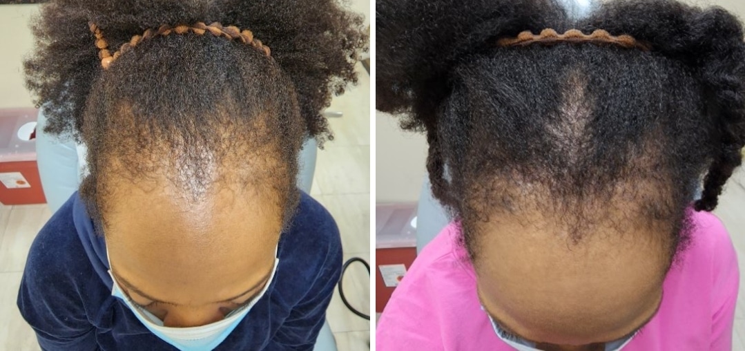 A before and after image of hair loss treatment for skin of color at Aglow Dermatology.