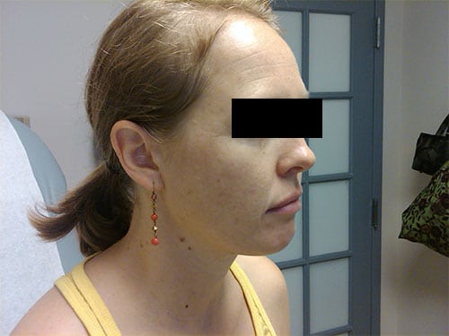 woman before chemical peel