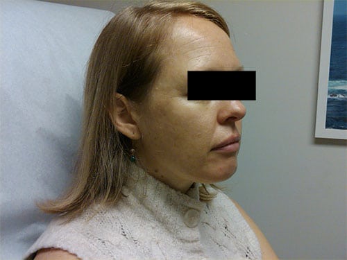 woman with clearer skin after chemical peel