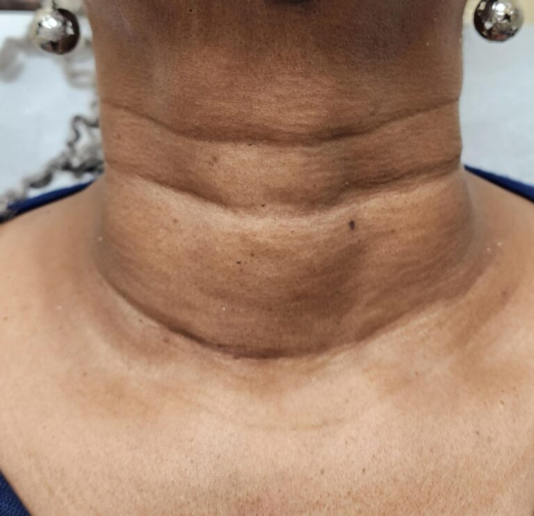Before Image: Neck line treatment before and after - front